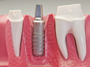 имплантация одного зуба